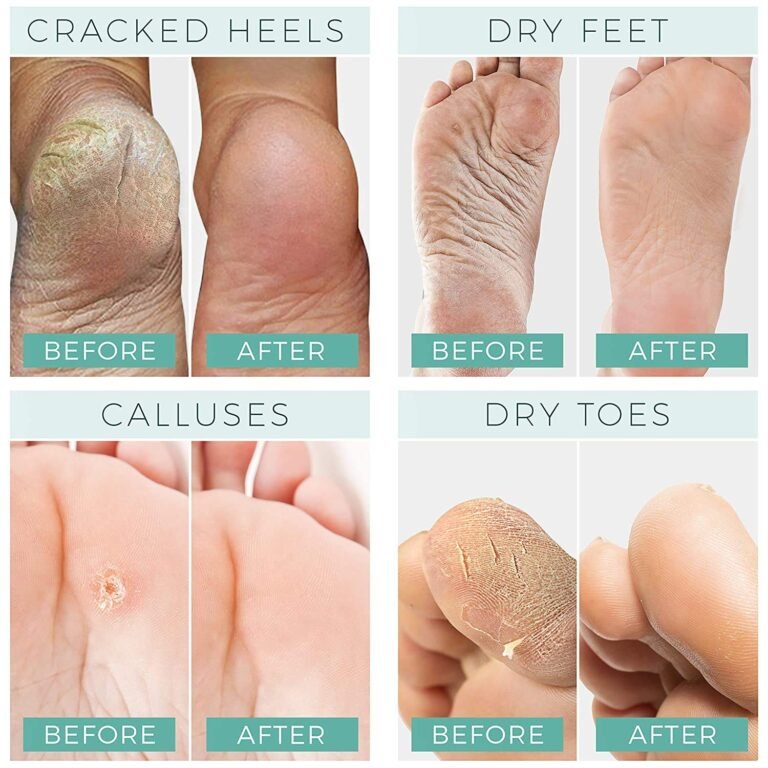 Foot Peel Mask - For Cracked Heels - Dead Skin Yelomoon 4